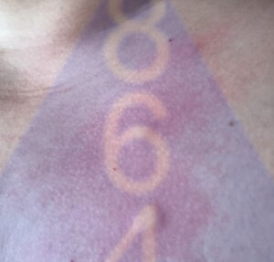 Imagen de picadura de chinches en la piel - Ejemplo 1