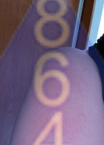 Imagen de picadura de chinches en la piel - Ejemplo 2