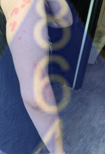 Imagen de picadura de chinches en la piel - Ejemplo 3