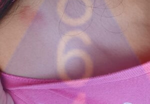 Imagen de picadura de chinches en la piel - Ejemplo 2-1