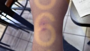 Imagen de picadura de chinches en la piel - Ejemplo 10