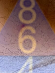 Imagen de picadura de chinches en la piel - Ejemplo 13