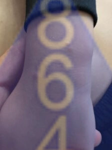 Imagen de picadura de chinches en la piel - Ejemplo 14