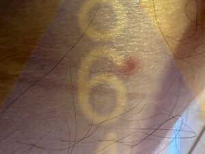 Imagen de picadura de chinches en la piel - Ejemplo 15