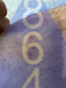 Imagen de picadura de chinches en la piel - Ejemplo 16