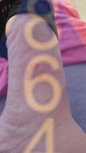 Imagen de picadura de chinches en la piel - Ejemplo 17