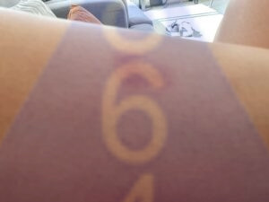 Imagen de picadura de chinches en la piel - Ejemplo 18