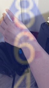 Imagen de picadura de chinches en la piel - Ejemplo 2-2