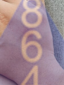 Imagen de picadura de chinches en la piel - Ejemplo 21