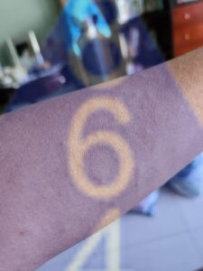 Imagen de picadura de chinches en la piel - Ejemplo 23