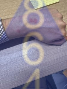 Imagen de picadura de chinches en la piel - Ejemplo 4-1