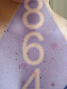 Imagen de picadura de chinches en la piel - Ejemplo 6