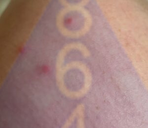 Imagen de picadura de chinches en la piel - Ejemplo 8