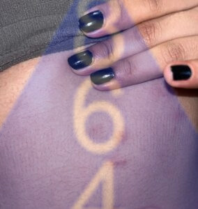 Imagen de picadura de chinches en la piel - Ejemplo 9